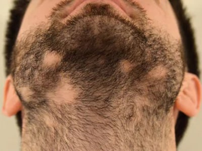 پیوند مو در ریش و سبیل به روش fut